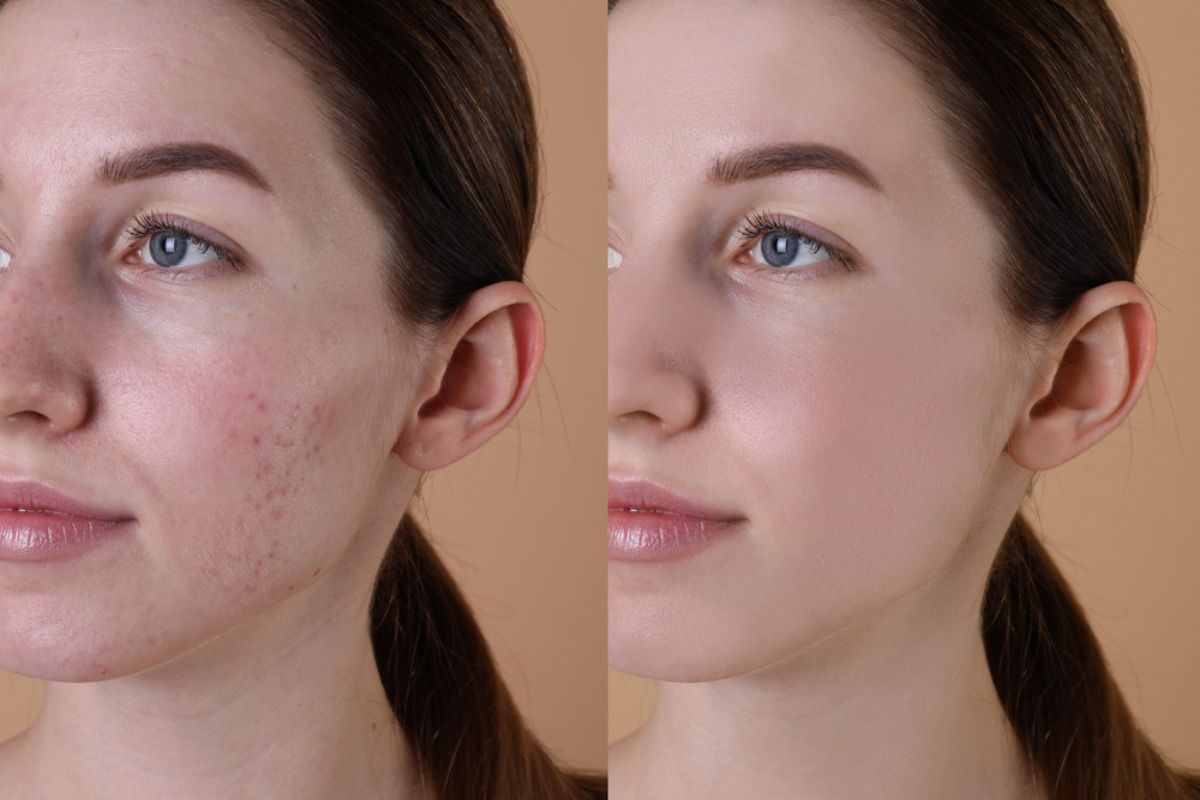 آر اف میکرونیدلینگ چیست؟ دلیل ترند شدن RF Microneedling