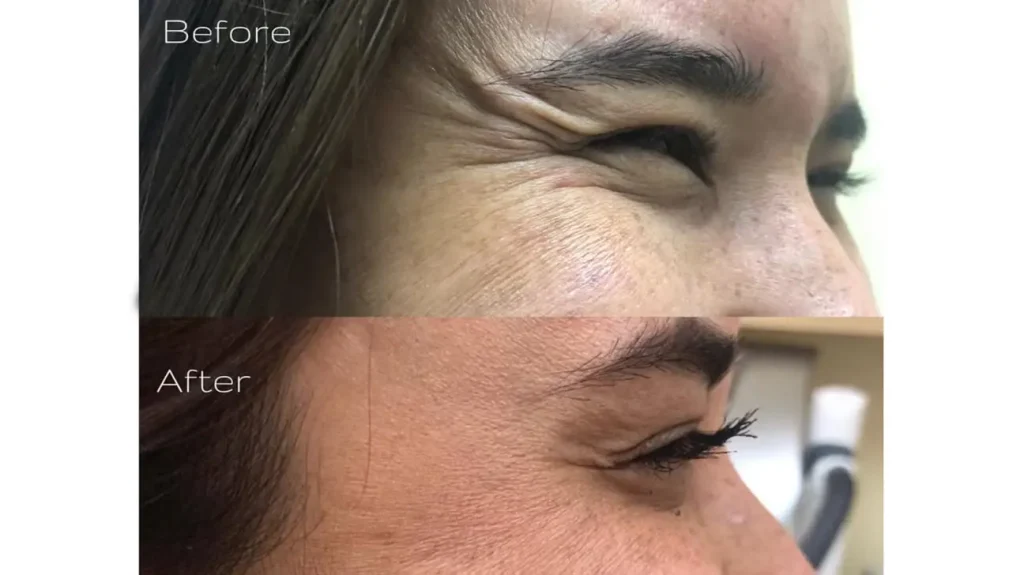 مزایا و کاربردهای Baby Botox در جوانسازی پوست